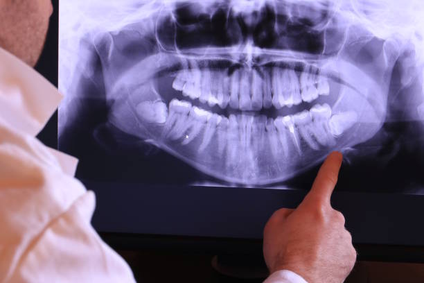 Best Emergency Wisdom Teeth Removal in Sullivan, IL